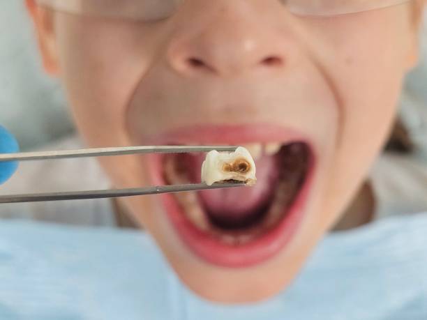 Urgent Tooth Repair in LA